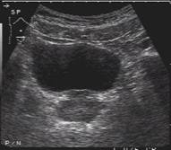 Visual aspect of healthy prostate and ADKP in Ultrasound images
