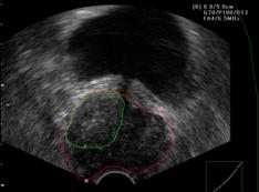 Visual aspect of healthy prostate and ADKP in Ultrasound images